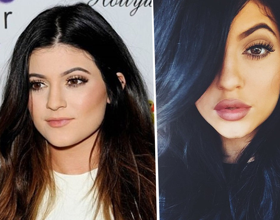 Cosa Si E Rifatta Kylie Jenner