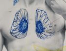 cicatrici 1